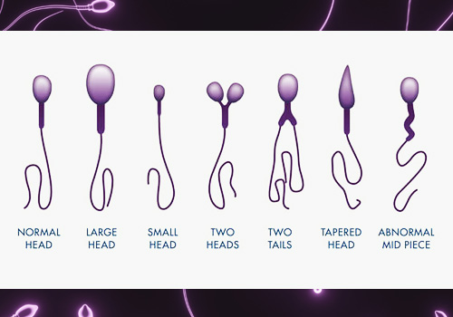 Male-Infertility